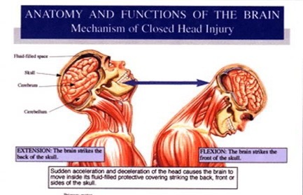 Illustration showing brain anatomy and functions during a closed head injury like a concussion. Two views depict 